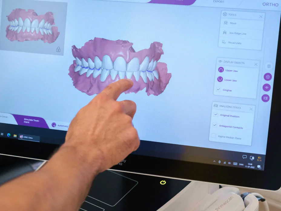 En person peger på en 3D scanning af en kundes tandsæt